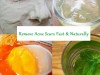Top Ways to Remove Acne Scars Fast in 7 Days
