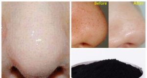 5 Super-Easy Remedies to Get Rid of Blackheads Instantly