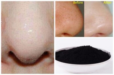 blackheads1
