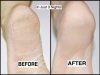 How to Get Rid of Cracked Heels in Just 3 Nights!