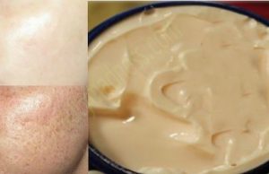 One Simple Cream that will Remove all Dark Spots in 10 Days