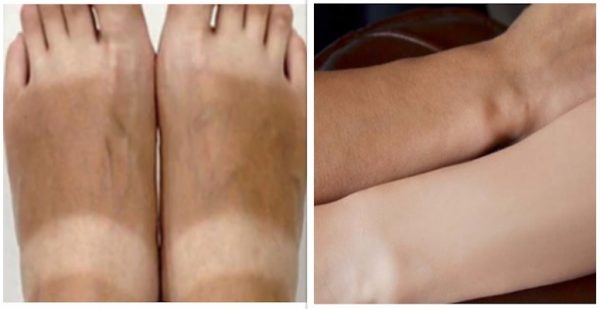 suntanremoval