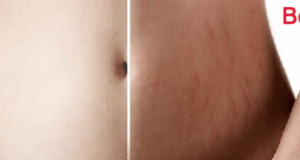 Banish stretch marks with this miracle pumpkin lotion!