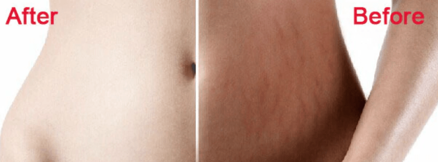 Banish stretch marks with this miracle pumpkin lotion!