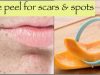 An amazing Face Peel to Fade Spots & Scars instant