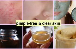 Top 5 tips for Oily skin to keep it clear & pimple-free