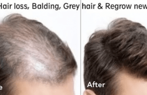 Regrow new hair | Stop hair loss | thebeautymadness