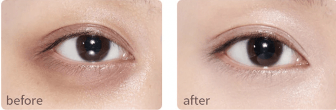 darkcircles