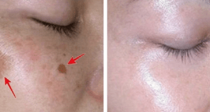 Lighten Up Your Skin: 6 Genius Hacks to Clear Dark Spots