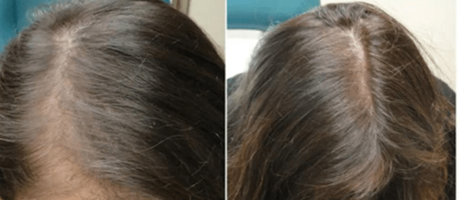 hairfall