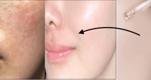 “Get Plump and Glowing Skin on a Budget: 5 Affordable Hyaluronic Acid Serums in India!”