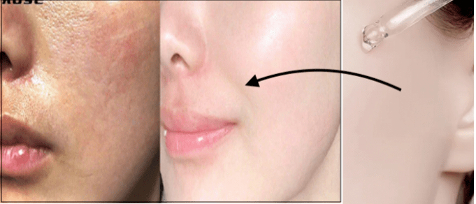 “Get Plump and Glowing Skin on a Budget: 5 Affordable Hyaluronic Acid Serums in India!”
