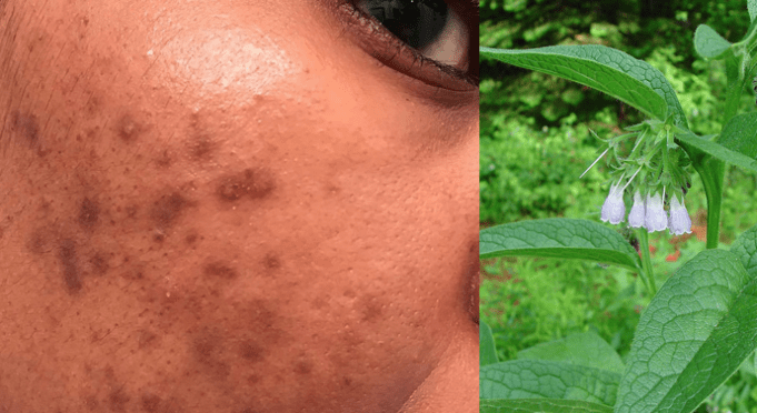 Pigmentation patches can be removed with this miracle formula! “I recommend that you try it, you may thank me later.”