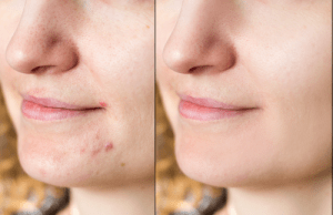 scrubs for “instant” clean clear skin, pimple-free skin