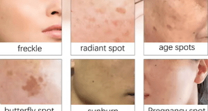 A Game-Changing Solution for Even Skin Tone Treatment