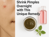 Shrink Pimples Overnight with This Unique Remedy